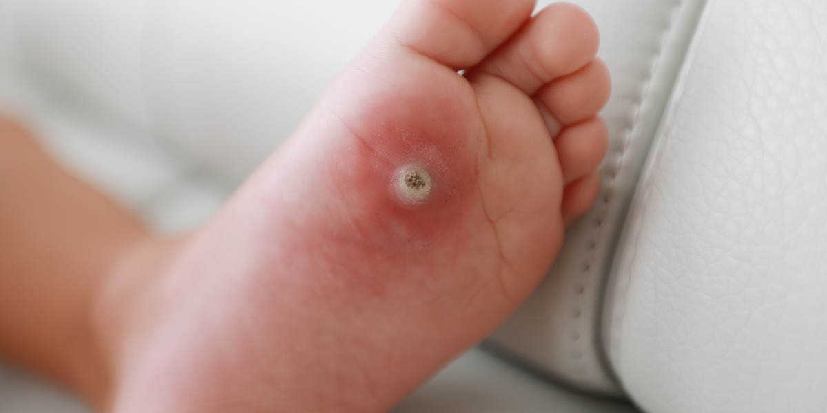 Stopa z owrzodzeniem i ranami – powikłania stopy cukrzycowej